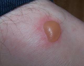 Zumaiako hitz bereziak: PUSLO